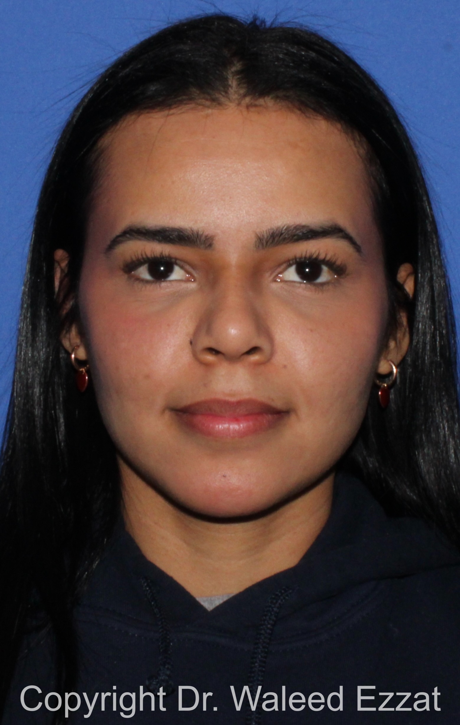 Forehead Reduction Patient Photo - Case 700 - after view-2