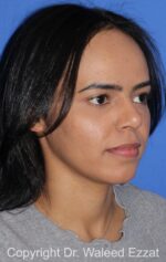 Forehead Reduction - Case 700 - Before