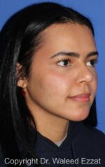 Forehead Reduction - Case 700 - After