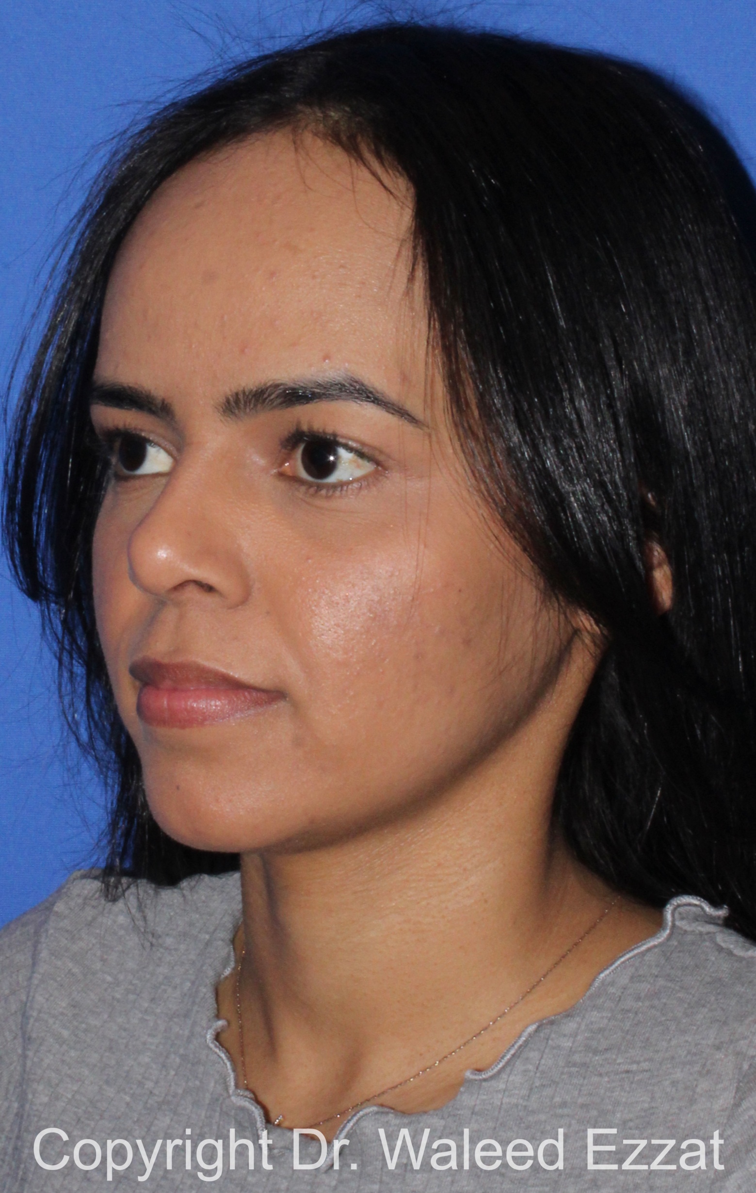 Forehead Reduction Patient Photo - Case 700 - before view-1