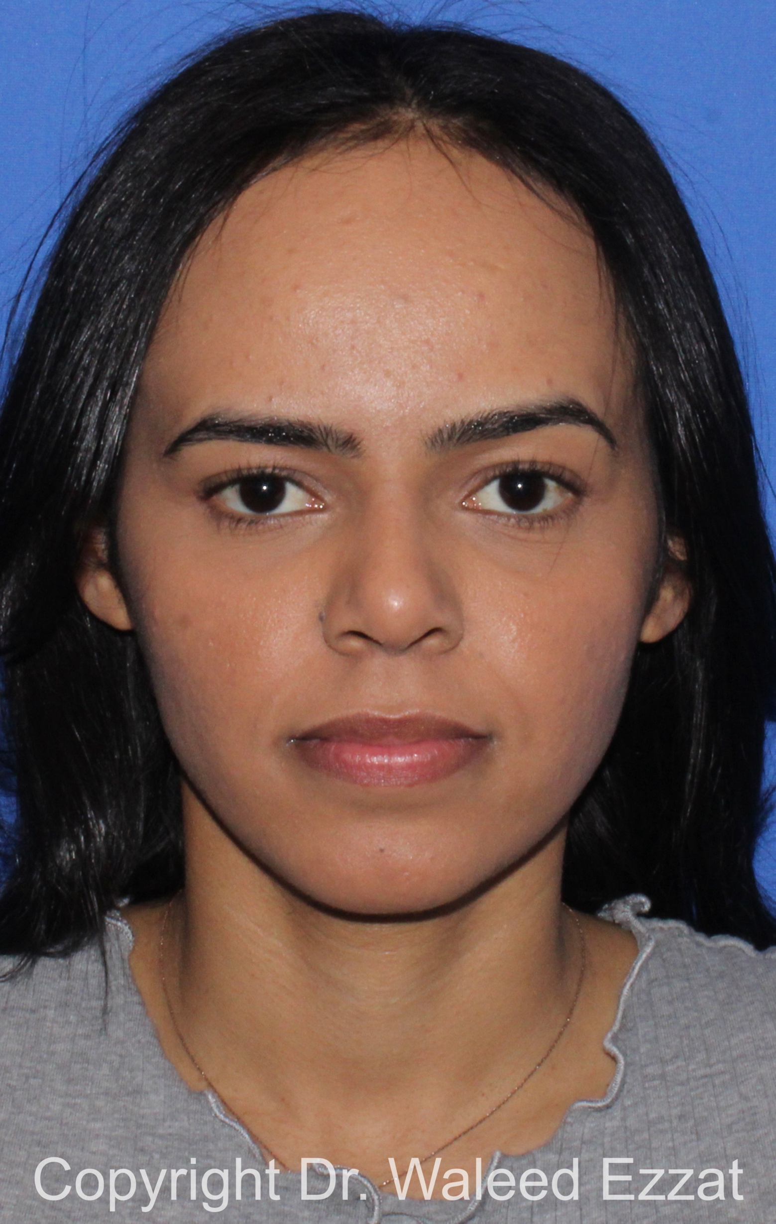 Forehead Reduction Patient Photo - Case 700 - before view-2