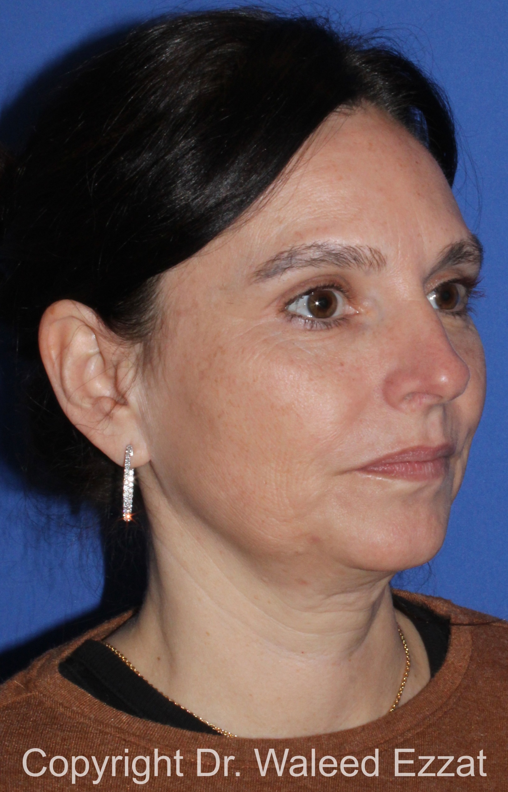 Facial Contouring Patient Photo - Case 140 - before view-1