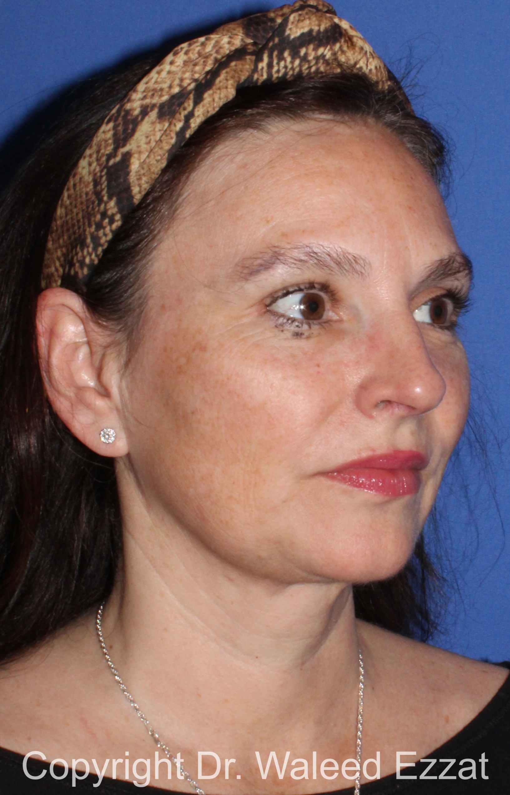 Facial Contouring Patient Photo - Case 140 - after view-1