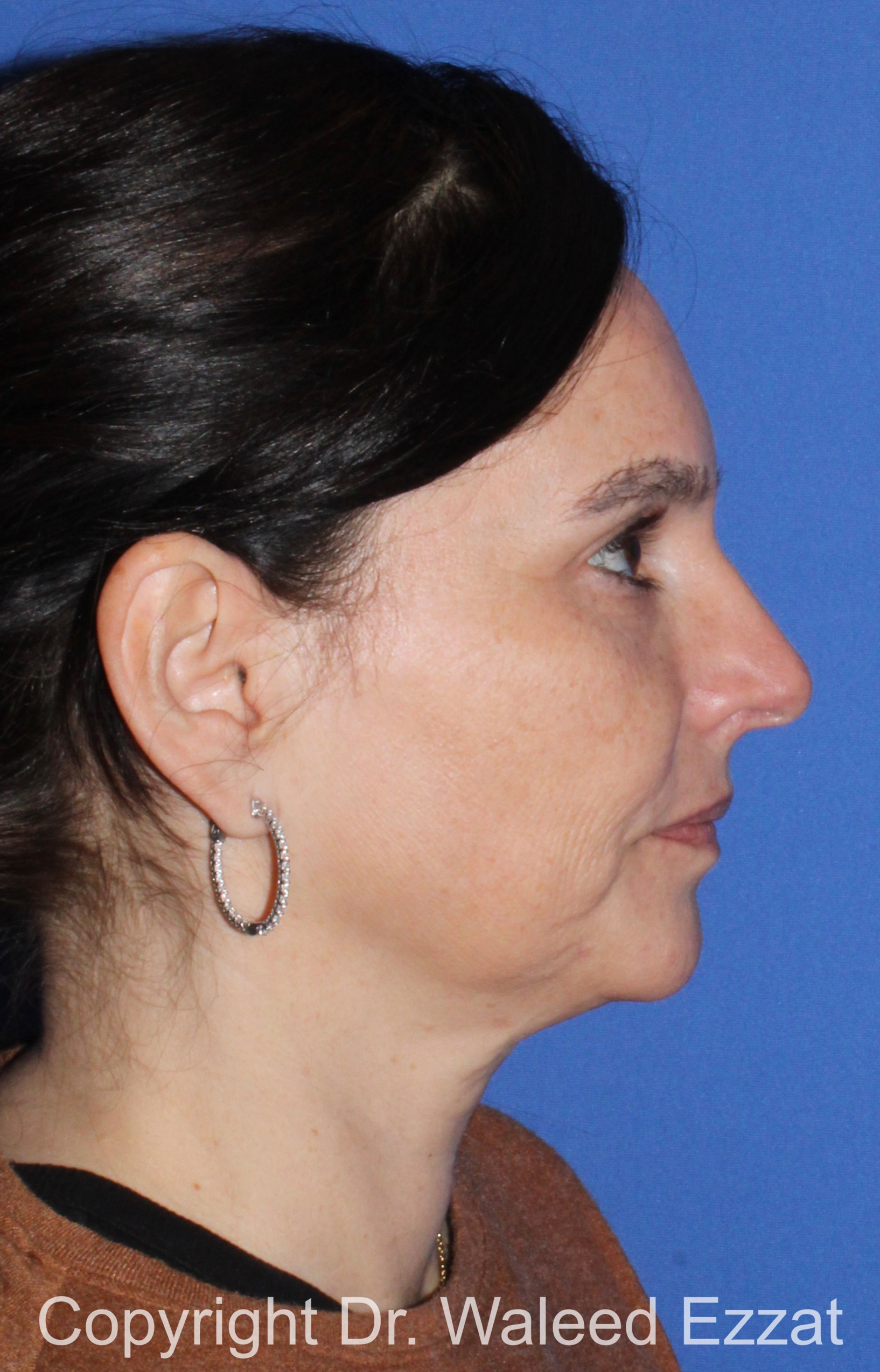 Facial Contouring Patient Photo - Case 140 - before view-