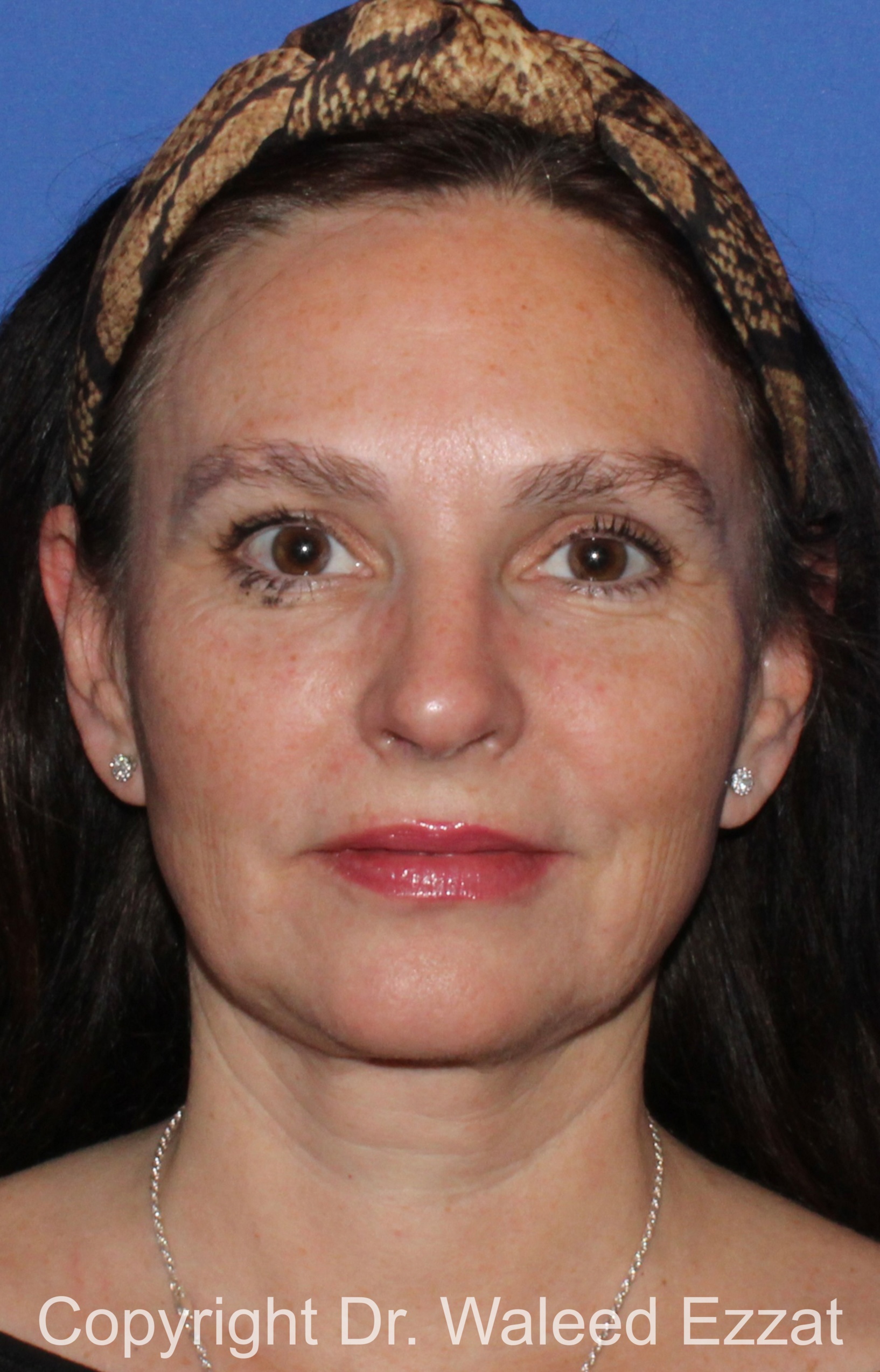 Facial Contouring Patient Photo - Case 140 - after view-2