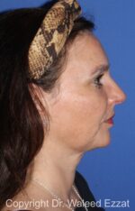 Facial Contouring - Case 140 - After