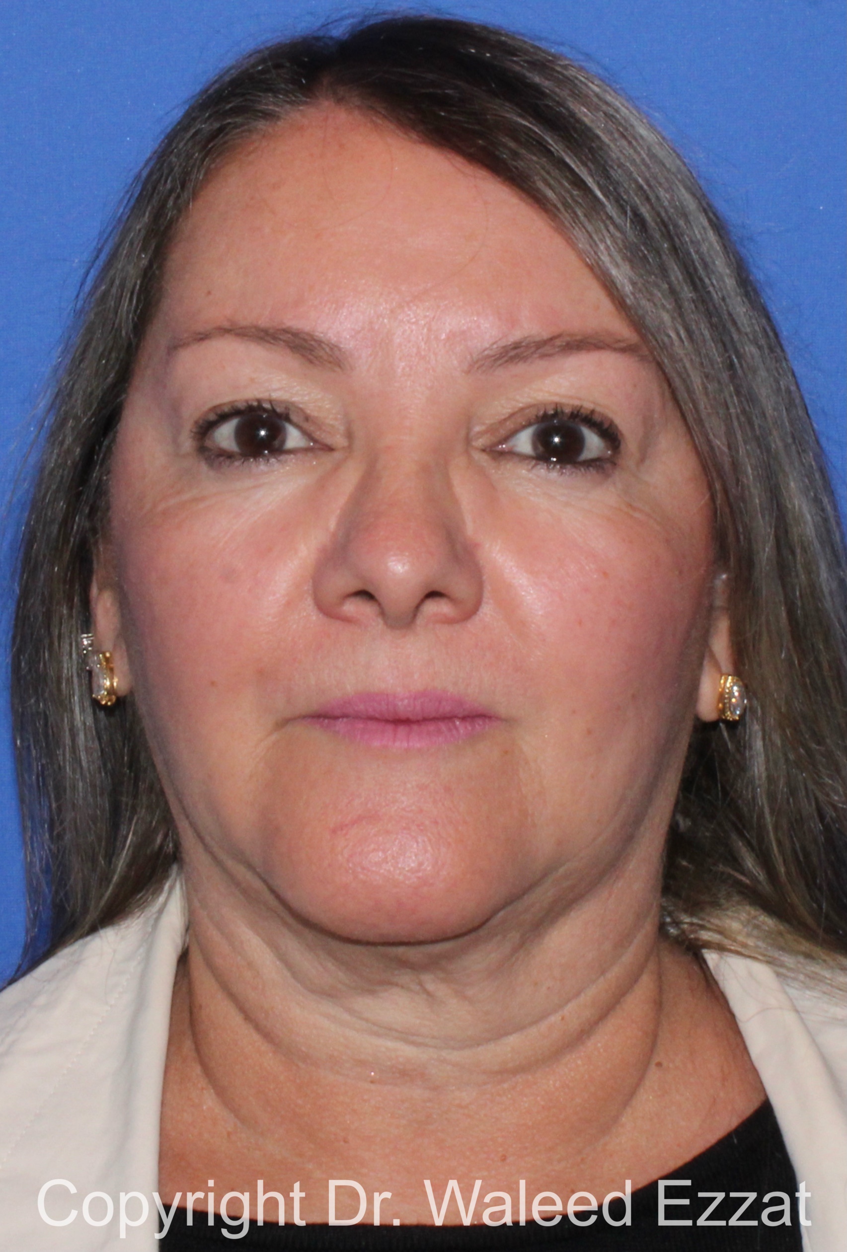 Facial Contouring Patient Photo - Case 141 - after view-2