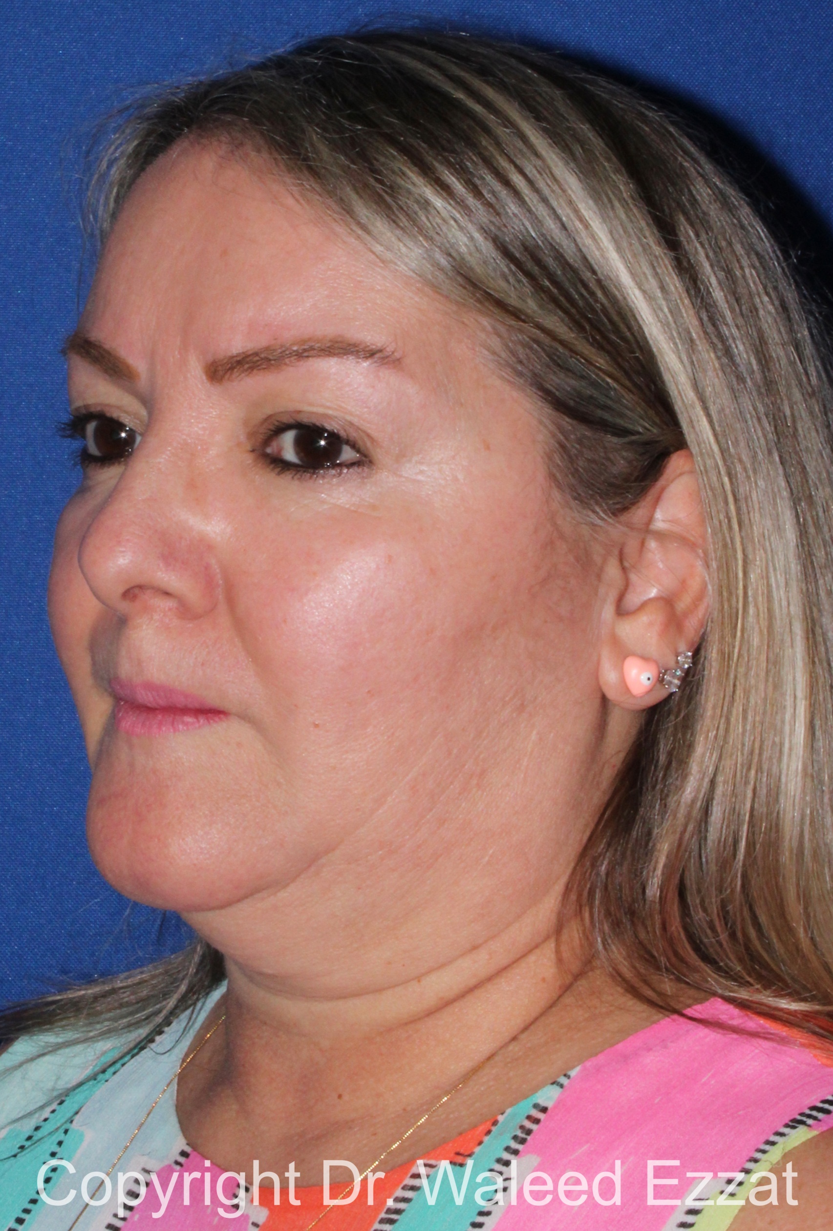 Facial Contouring Patient Photo - Case 141 - before view-1