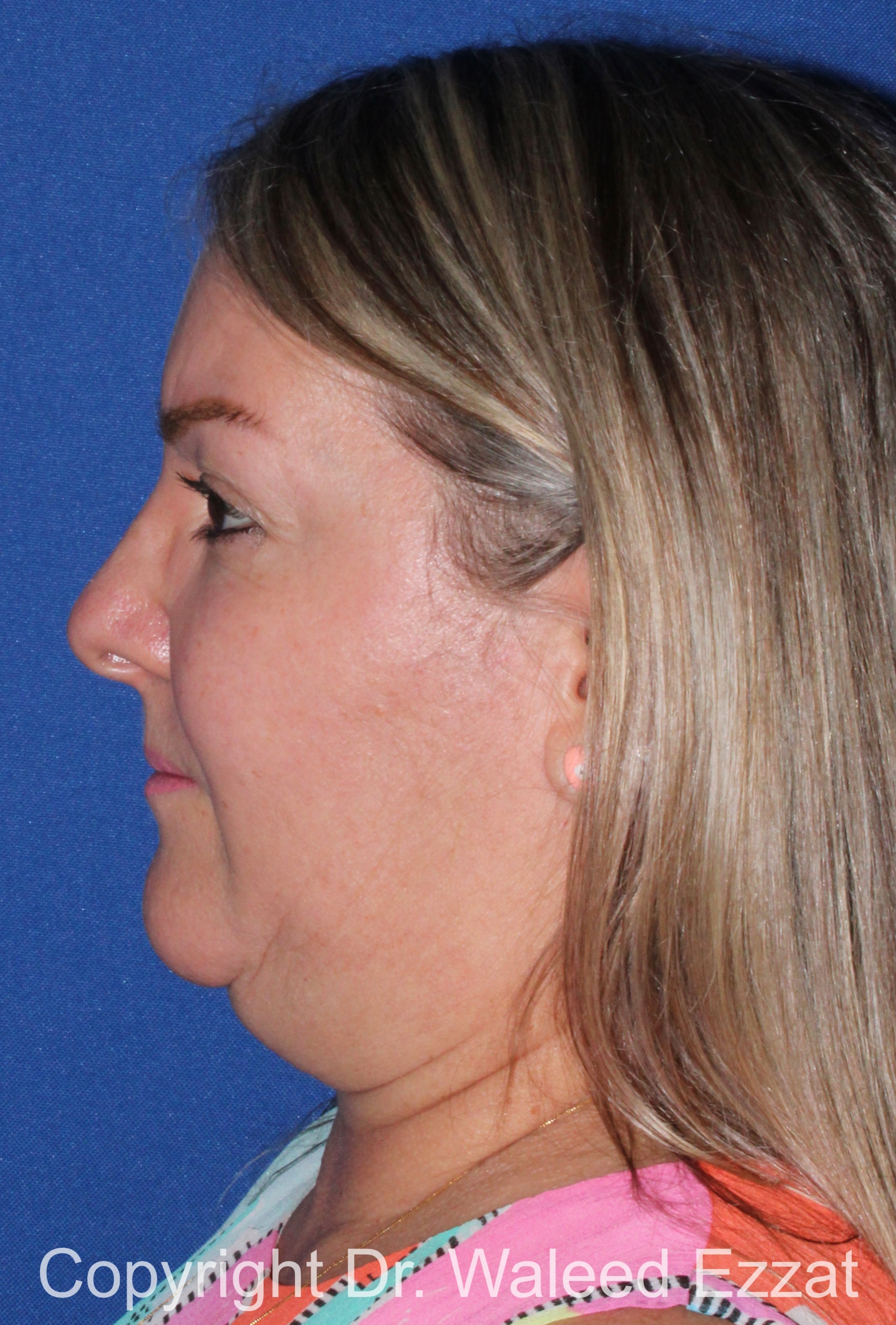 Facial Contouring Patient Photo - Case 141 - before view-