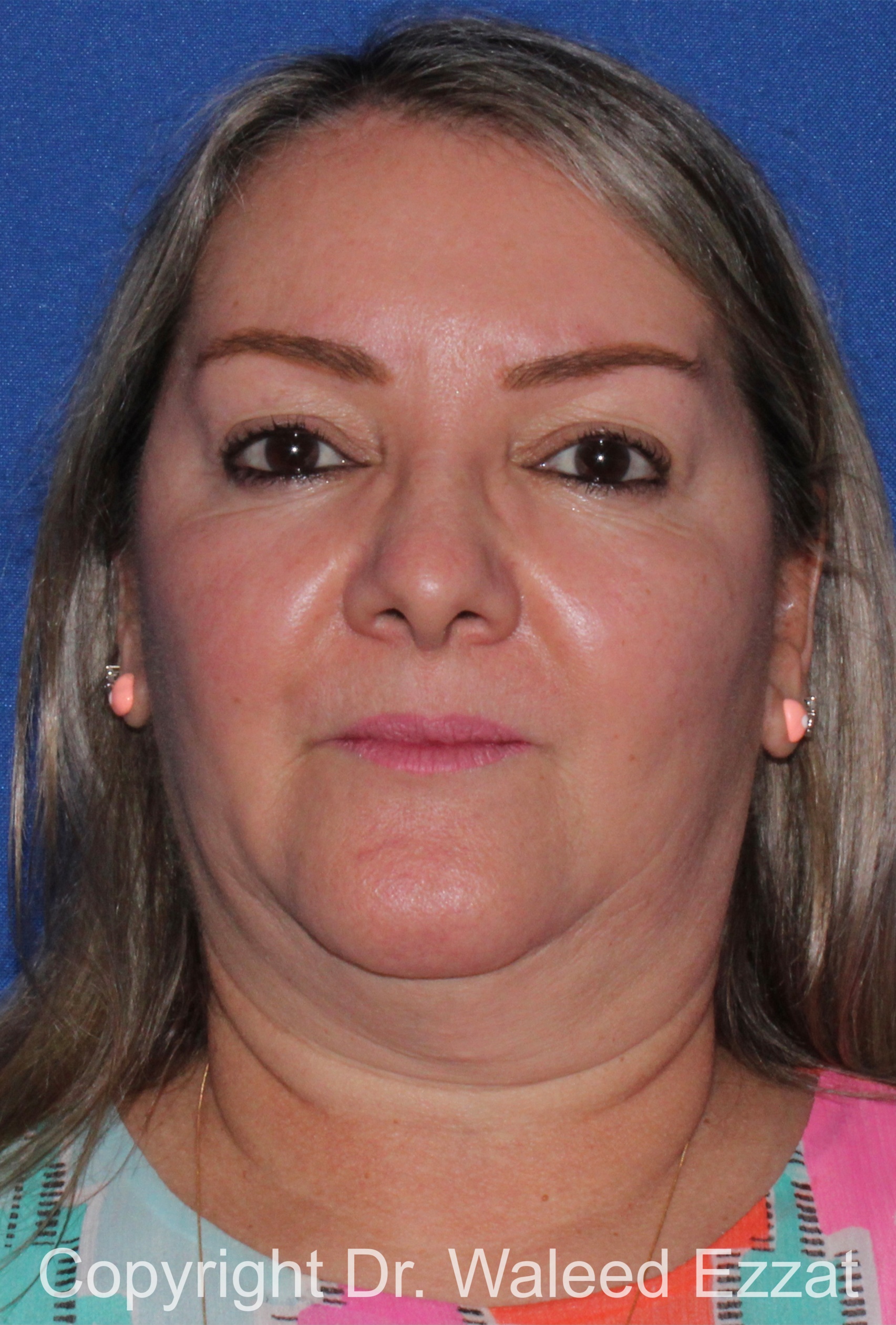 Facial Contouring Patient Photo - Case 141 - before view-2