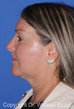 Facial Contouring - Case 141 - After