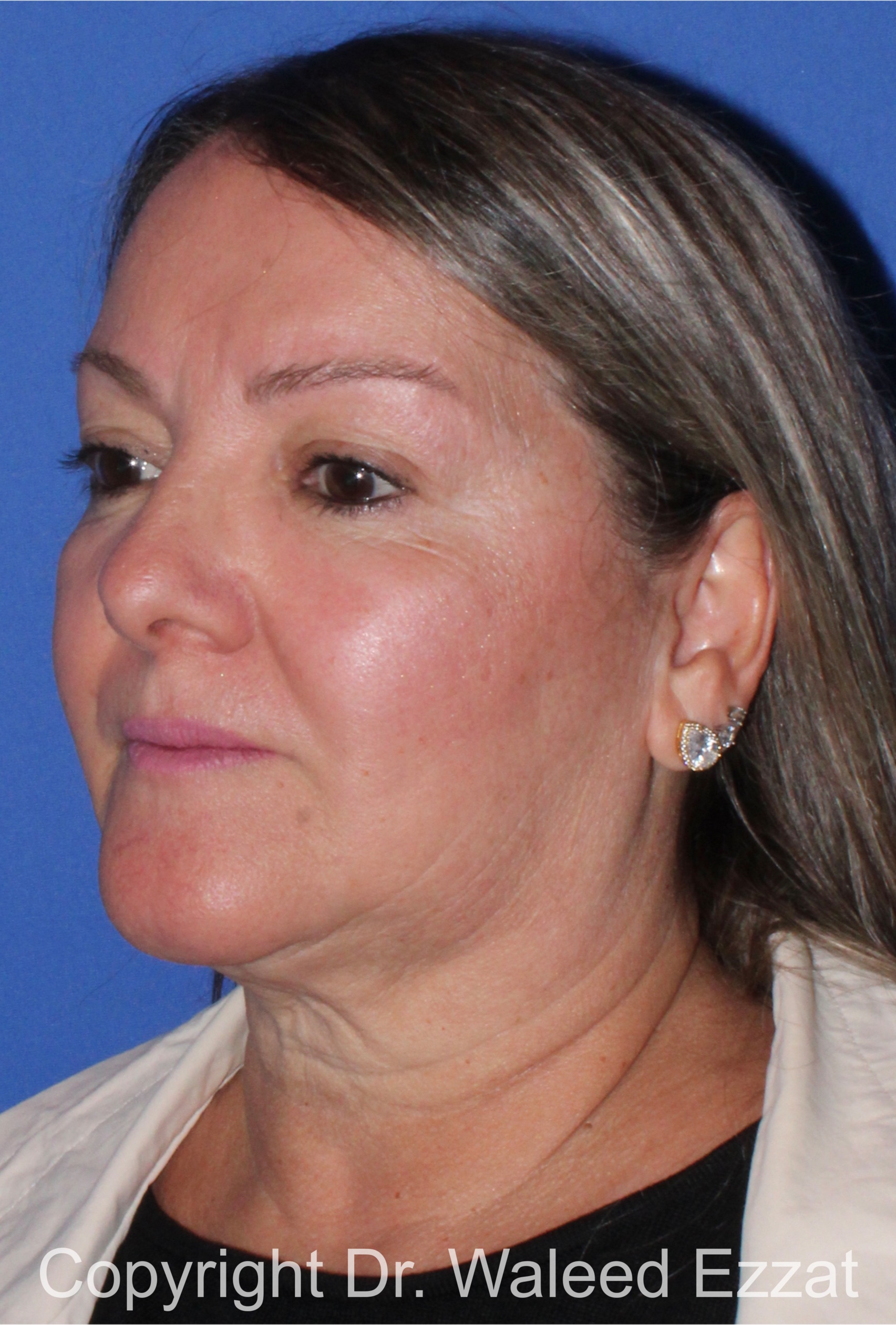 Facial Contouring Patient Photo - Case 141 - after view-1