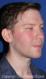 Facial Contouring - Case 144 - After