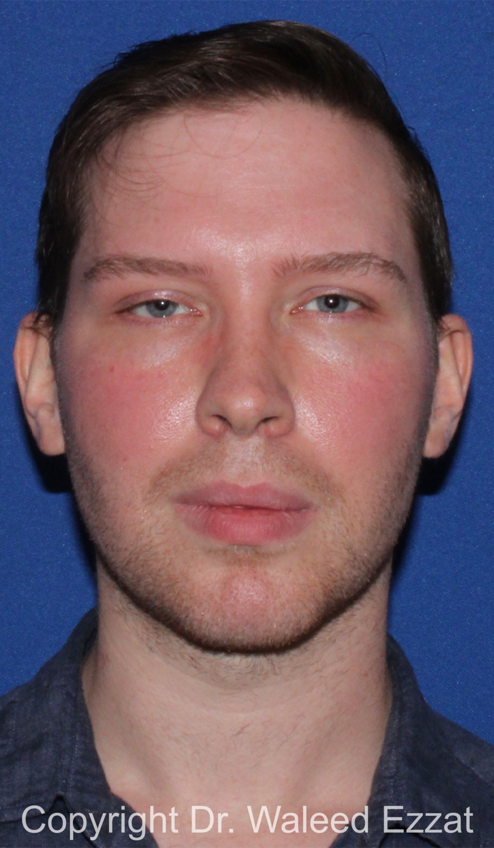 Facial Contouring Patient Photo - Case 144 - after view-2