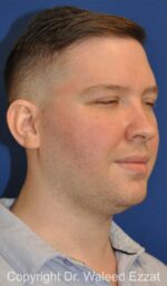 Facial Contouring - Case 144 - Before