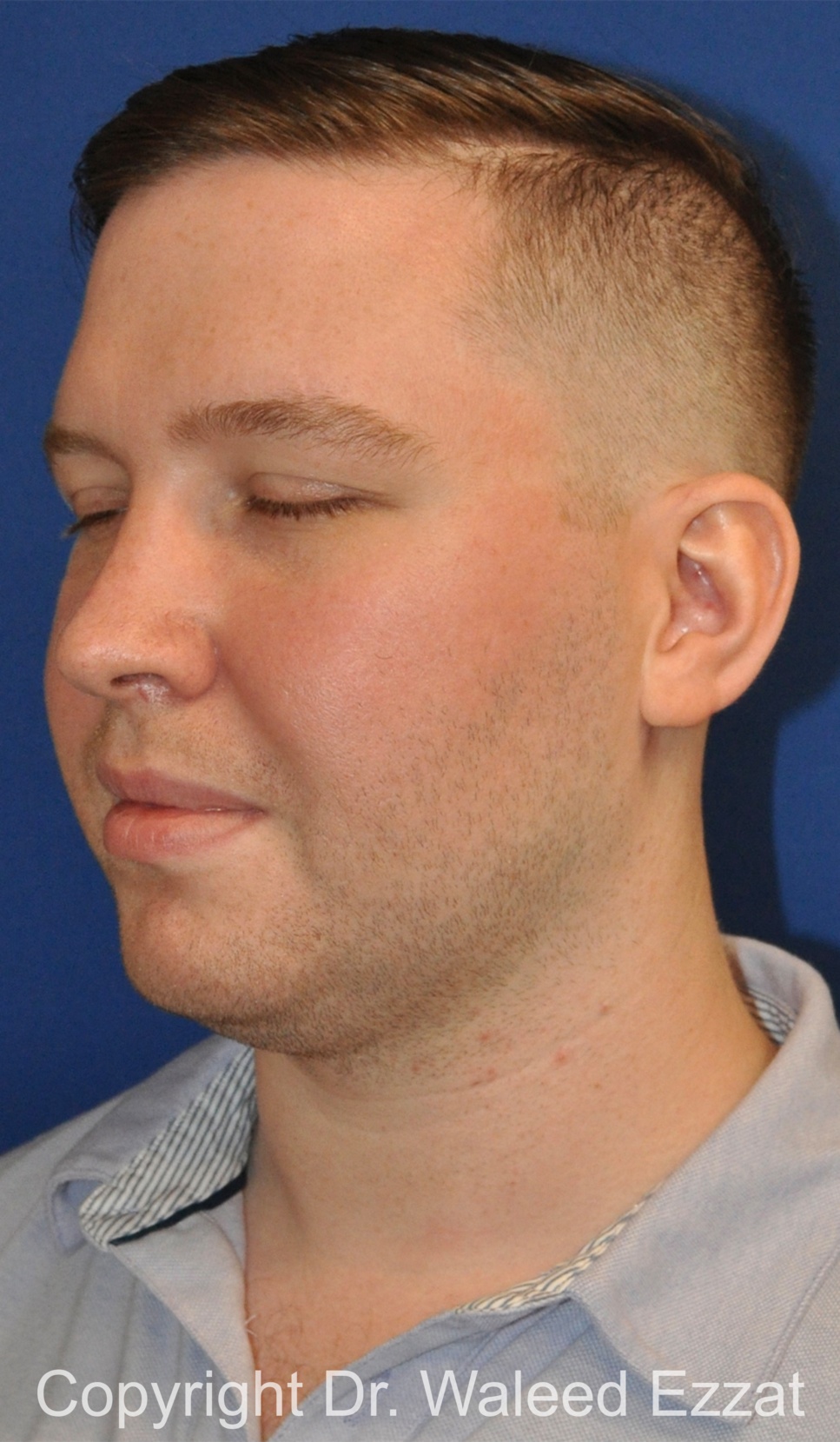 Facial Contouring Patient Photo - Case 144 - before view-1