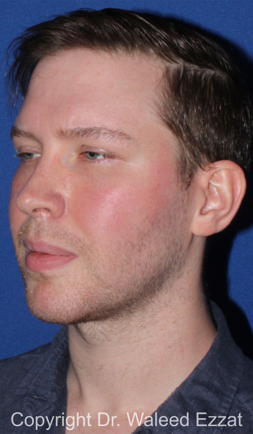 Facial Contouring Patient Photo - Case 144 - after view-1