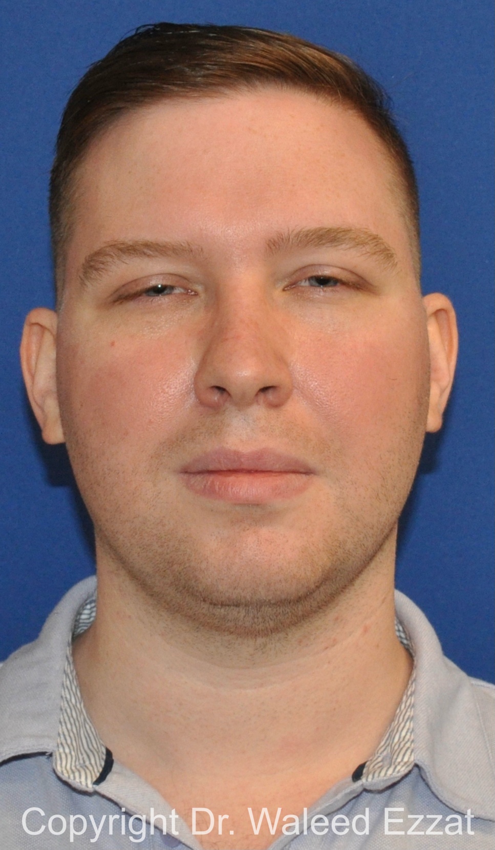 Facial Contouring Patient Photo - Case 144 - before view-2