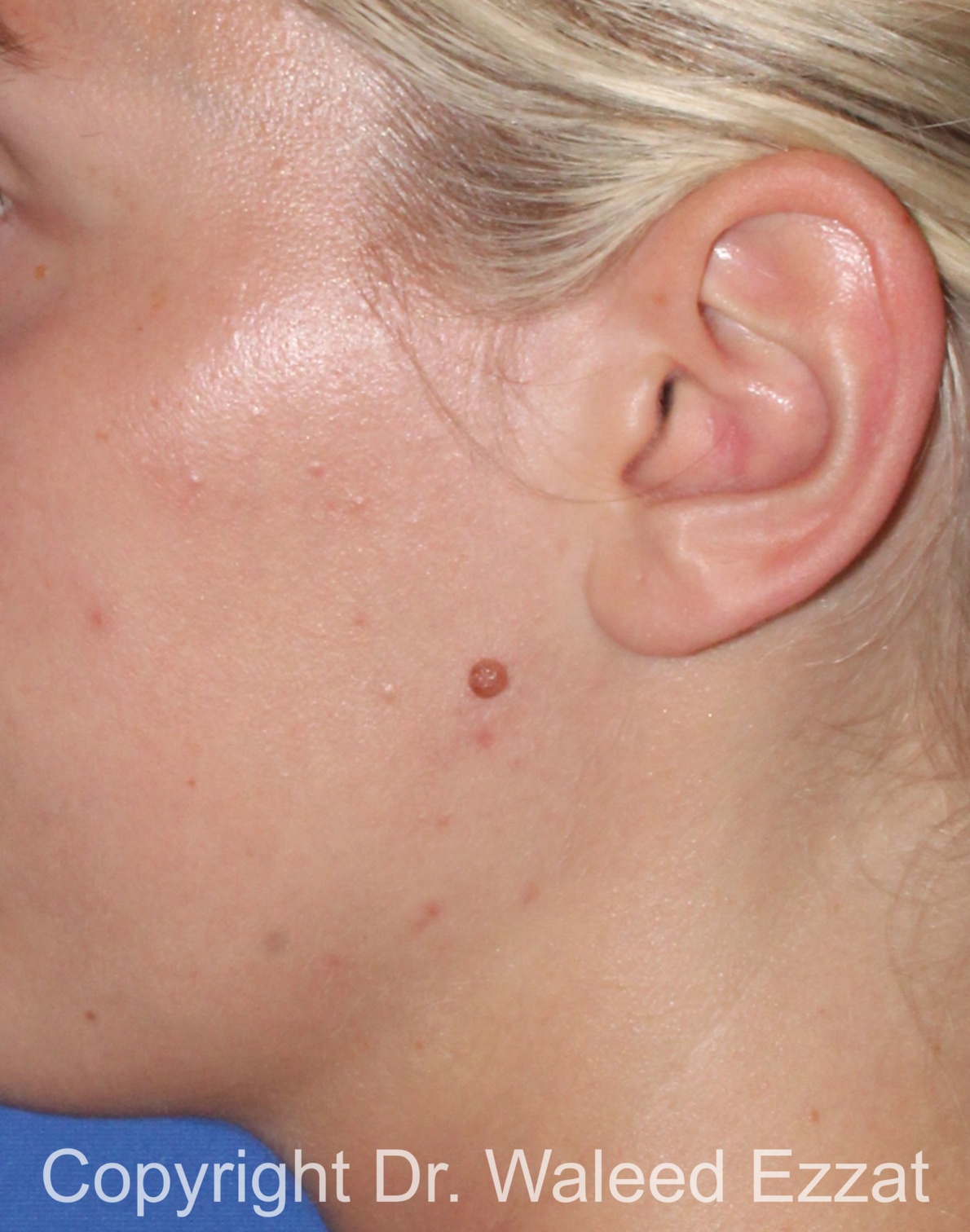 Mole Removal Patient Photo - Case 120 - before view-