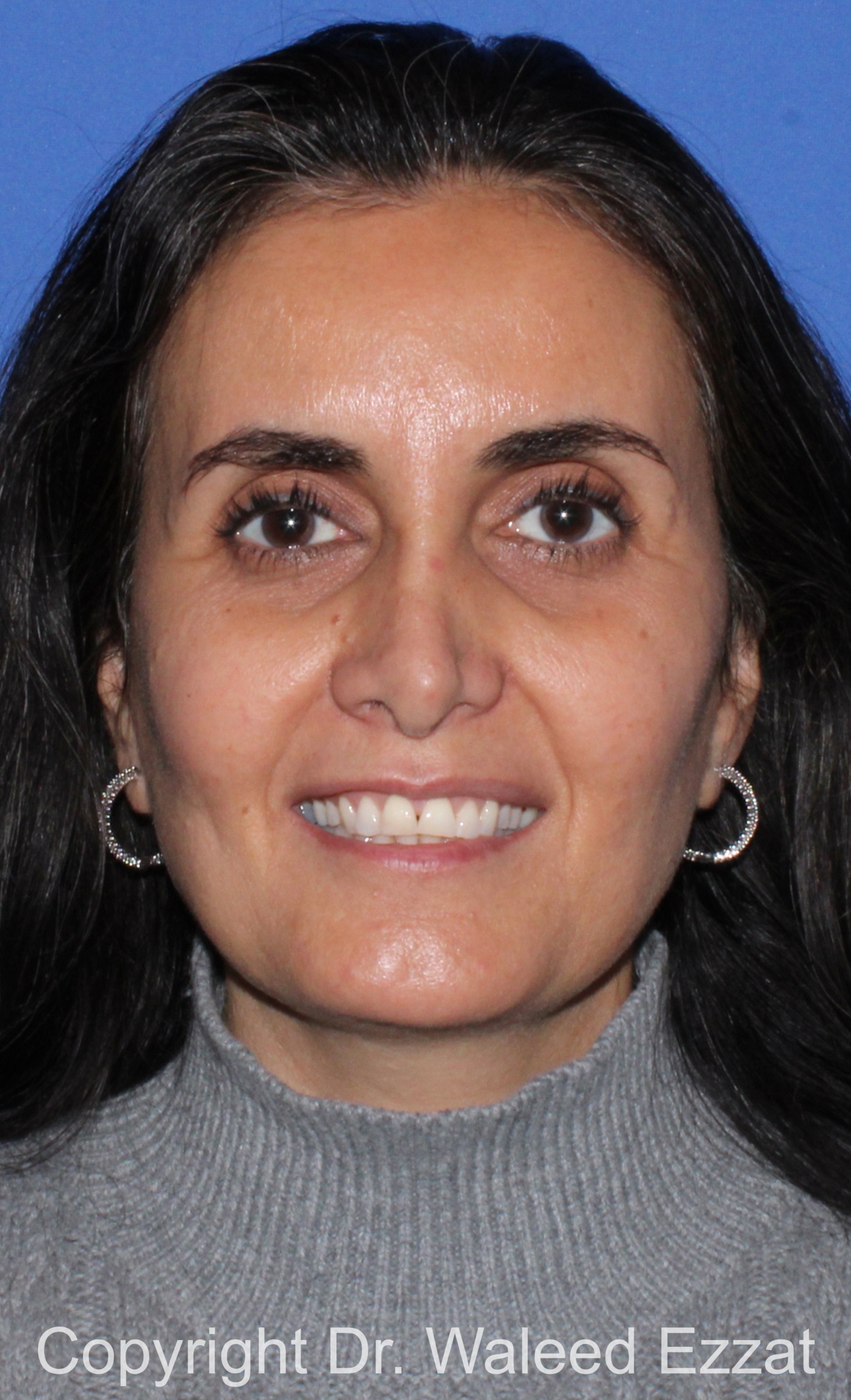 Mole Removal Patient Photo - Case 121 - after view-1