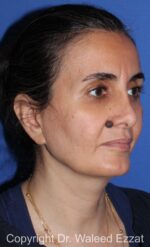 Mole Removal - Case 121 - Before