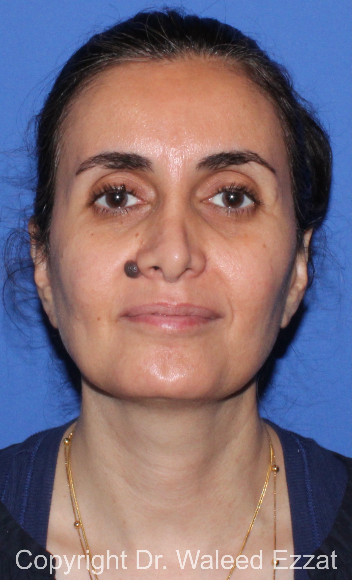 Mole Removal Patient Photo - Case 121 - before view-1