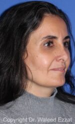 Mole Removal - Case 121 - After