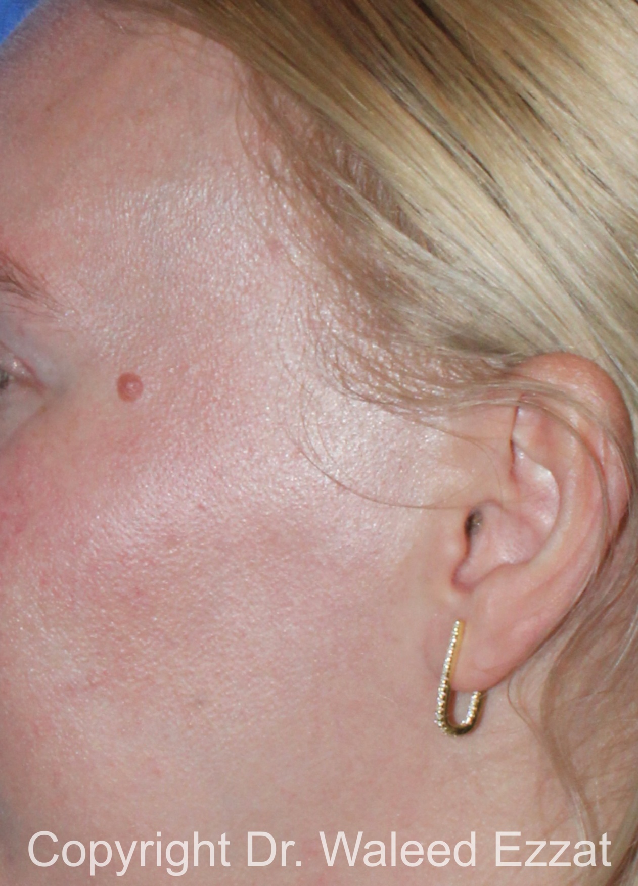 Mole Removal Patient Photo - Case 122 - before view-