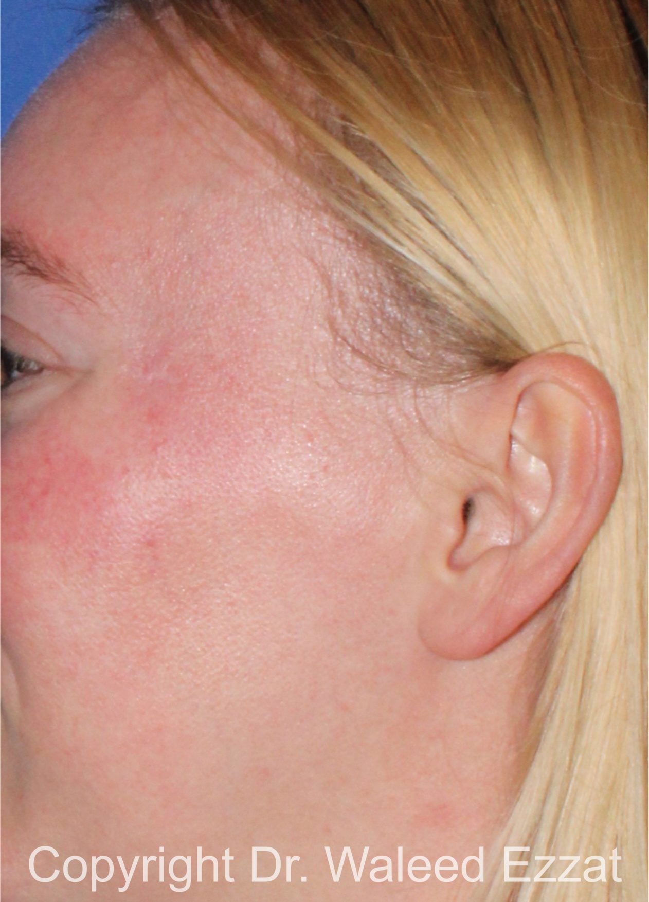 Mole Removal Patient Photo - Case 122 - after view