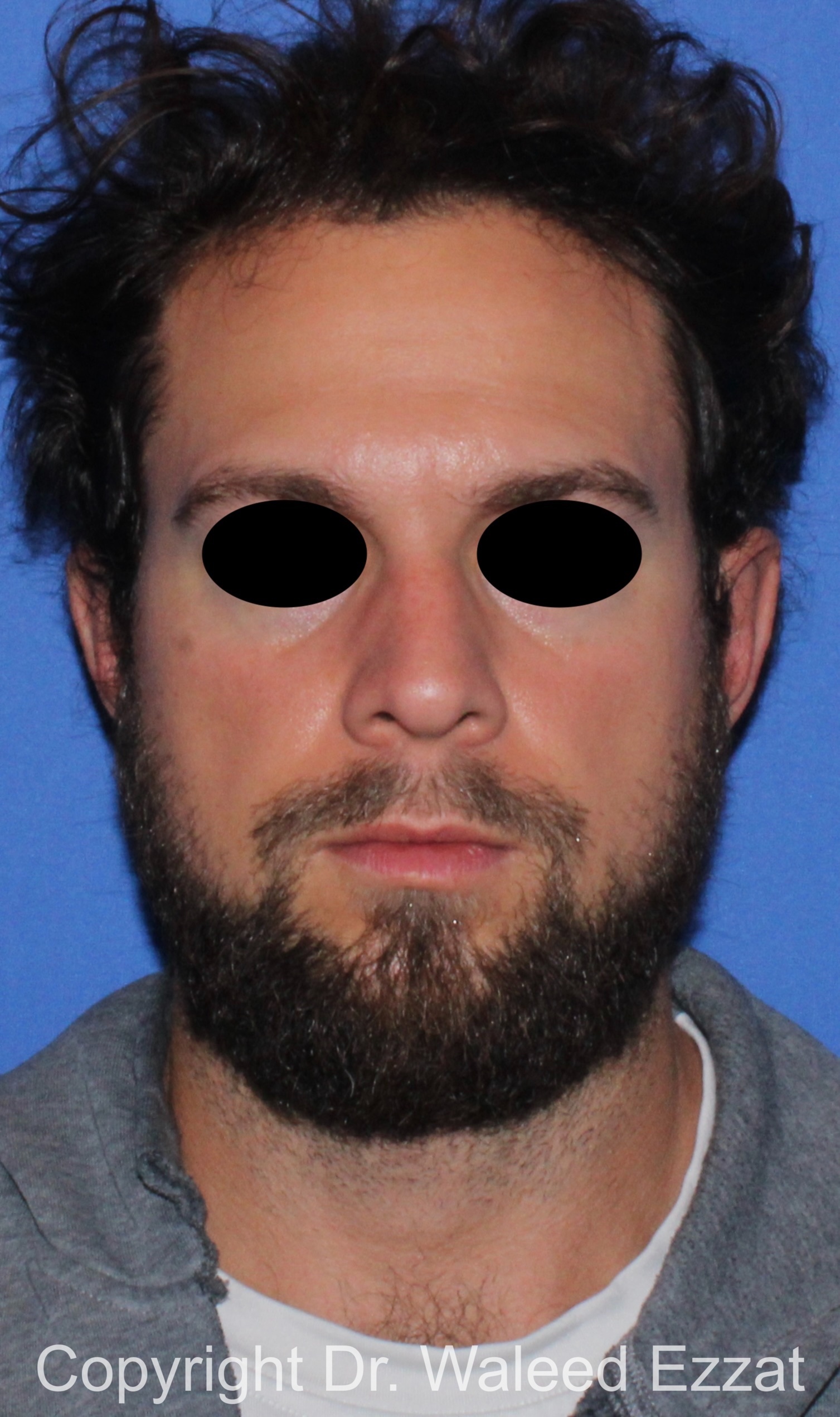 Otoplasty (Ear Re-Shaping Surgery) Patient Photo - Case 101 - after view