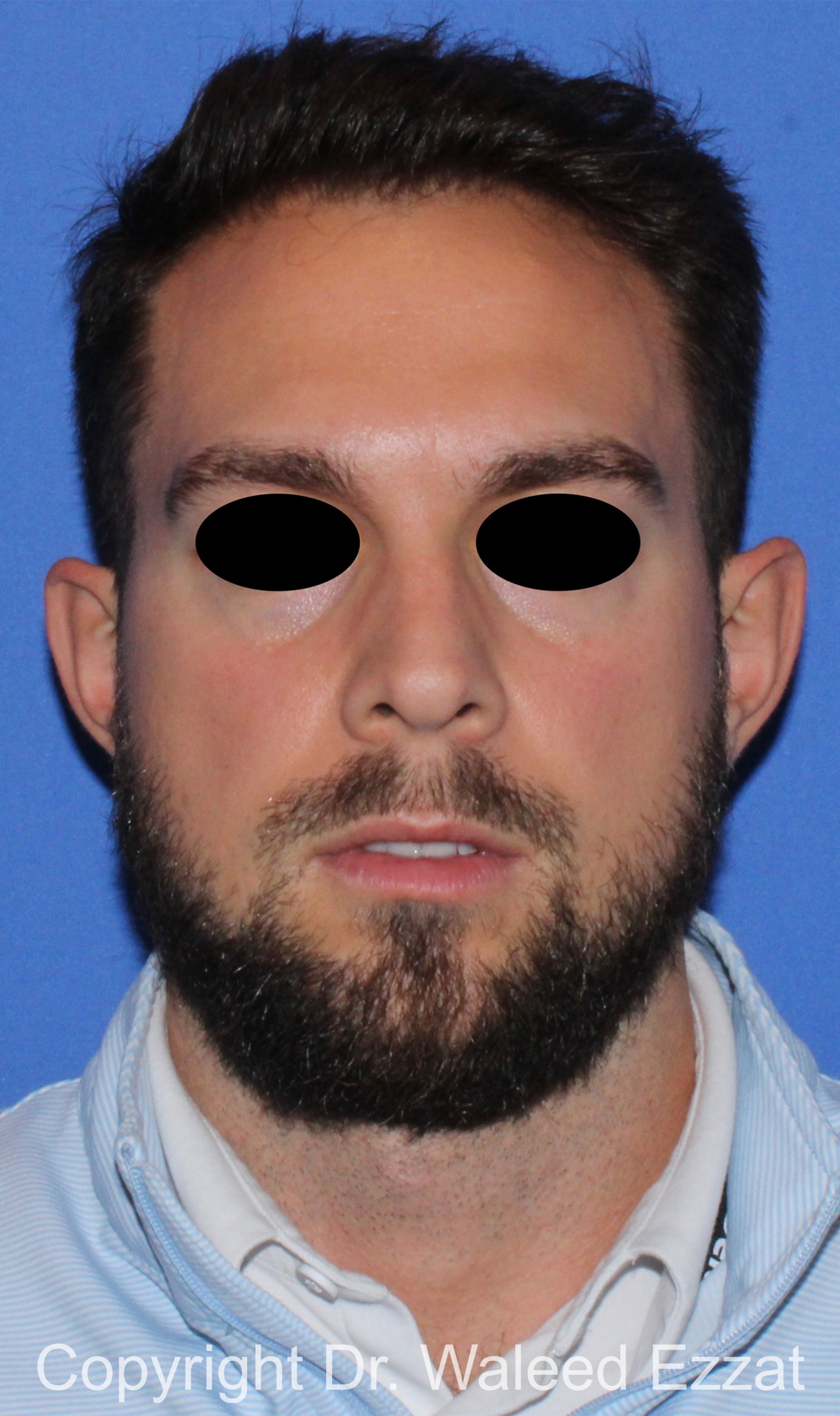 Otoplasty (Ear Re-Shaping Surgery) Patient Photo - Case 101 - before view-