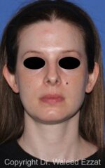 Otoplasty (Ear Re-Shaping Surgery) - Case 102 - Before