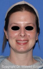 Otoplasty (Ear Re-Shaping Surgery) - Case 102 - After