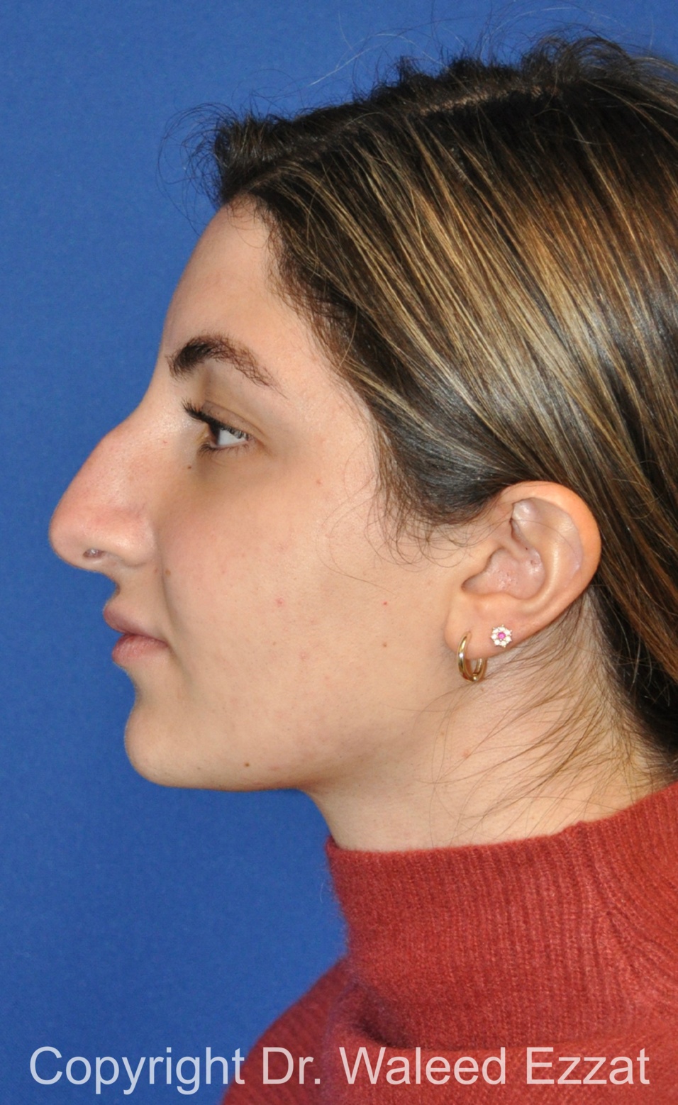 Mediterranean/Middle Eastern Rhinoplasty Patient Photo - Case 656 - before view-