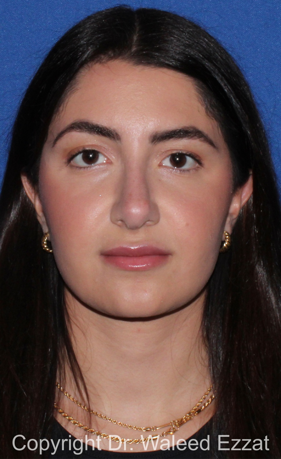 Mediterranean/Middle Eastern Rhinoplasty Patient Photo - Case 656 - after view-2