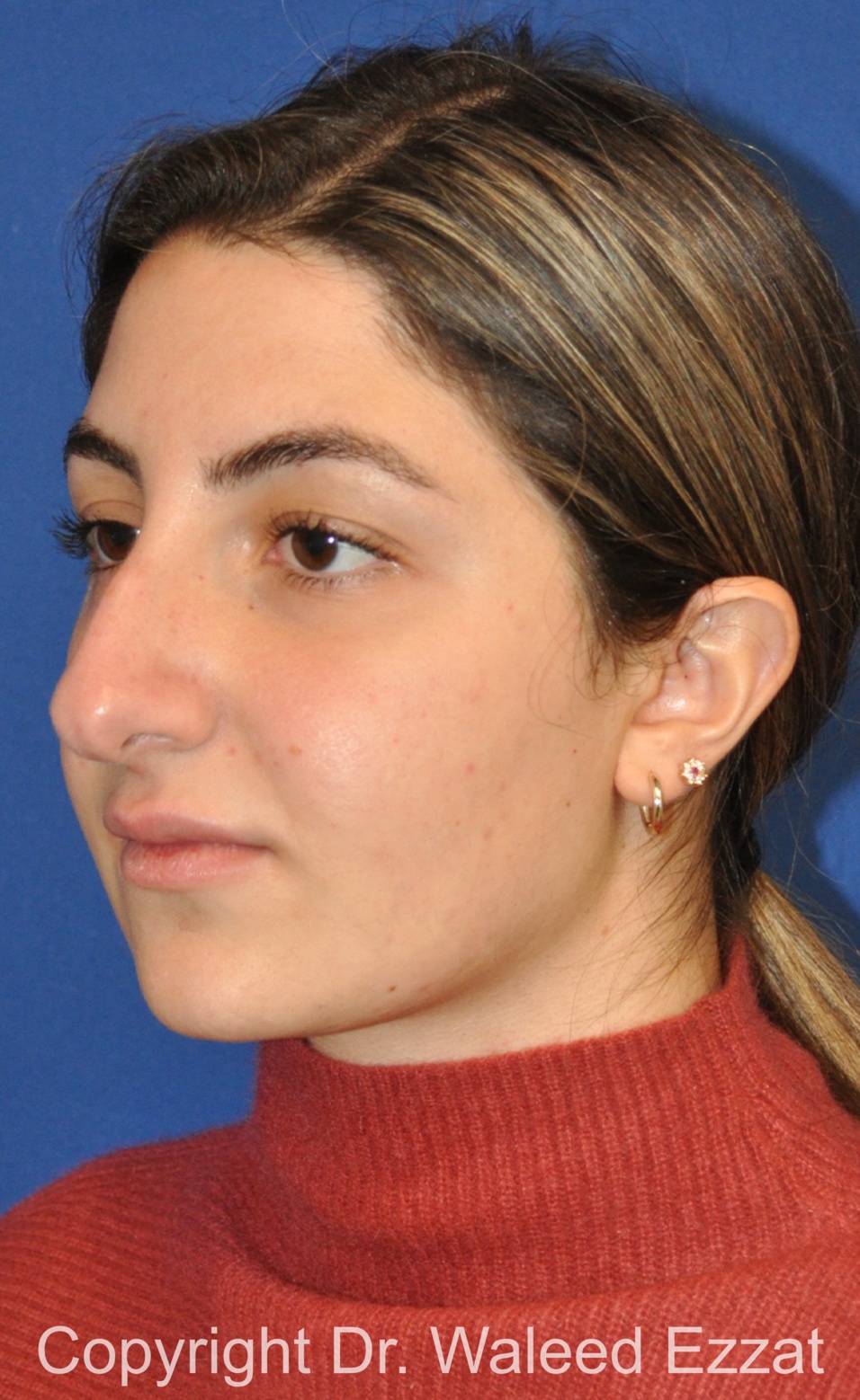 Mediterranean/Middle Eastern Rhinoplasty Patient Photo - Case 656 - before view-1