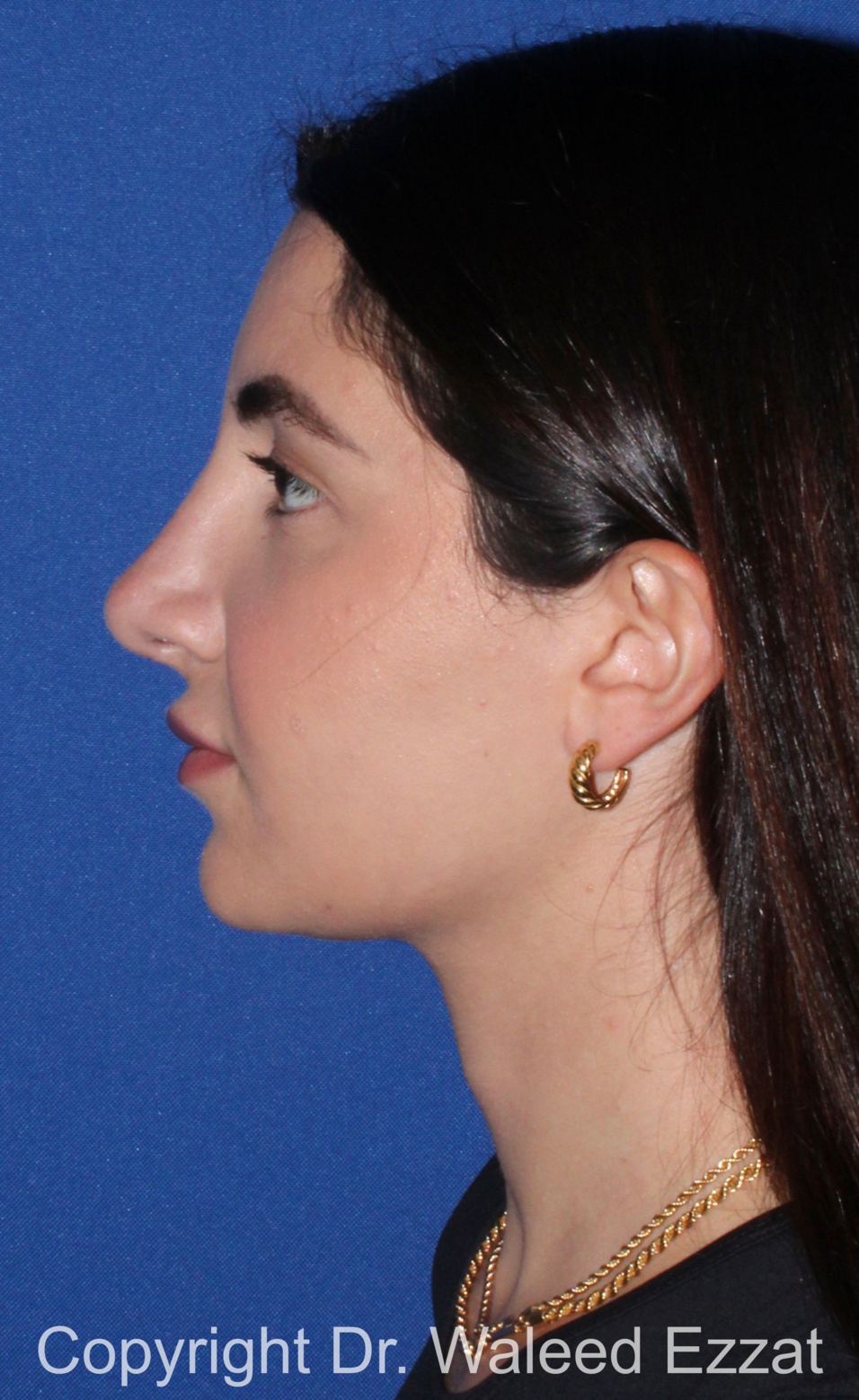 Mediterranean/Middle Eastern Rhinoplasty Patient Photo - Case 656 - after view