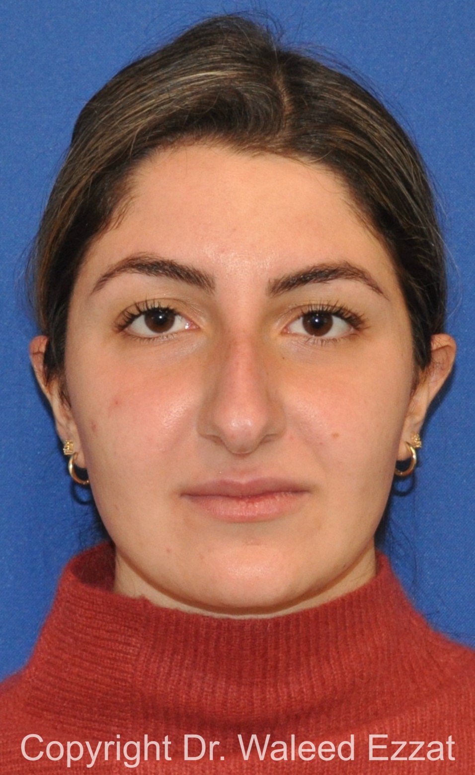 Mediterranean/Middle Eastern Rhinoplasty Patient Photo - Case 656 - before view-2
