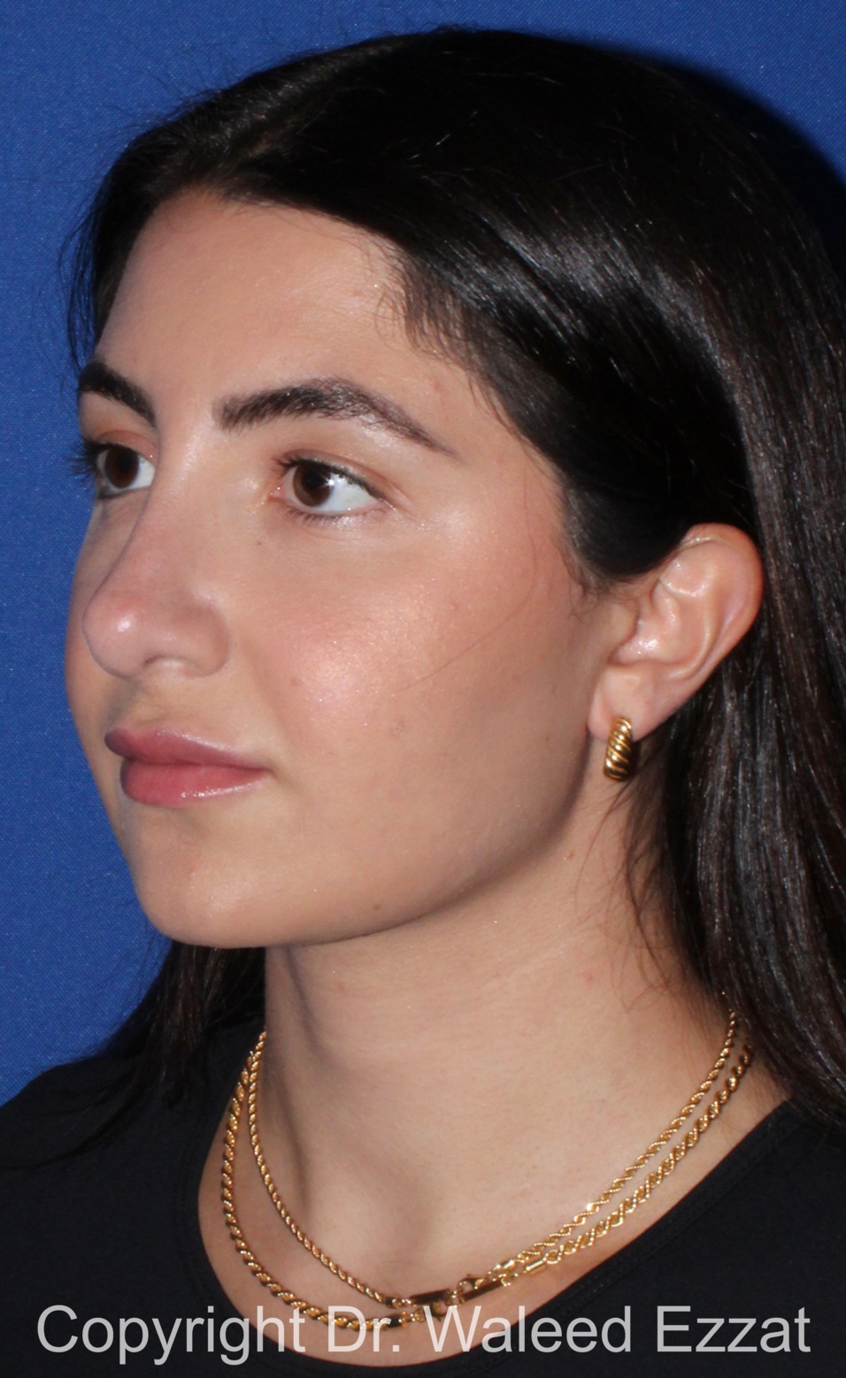 Mediterranean/Middle Eastern Rhinoplasty Patient Photo - Case 656 - after view-1