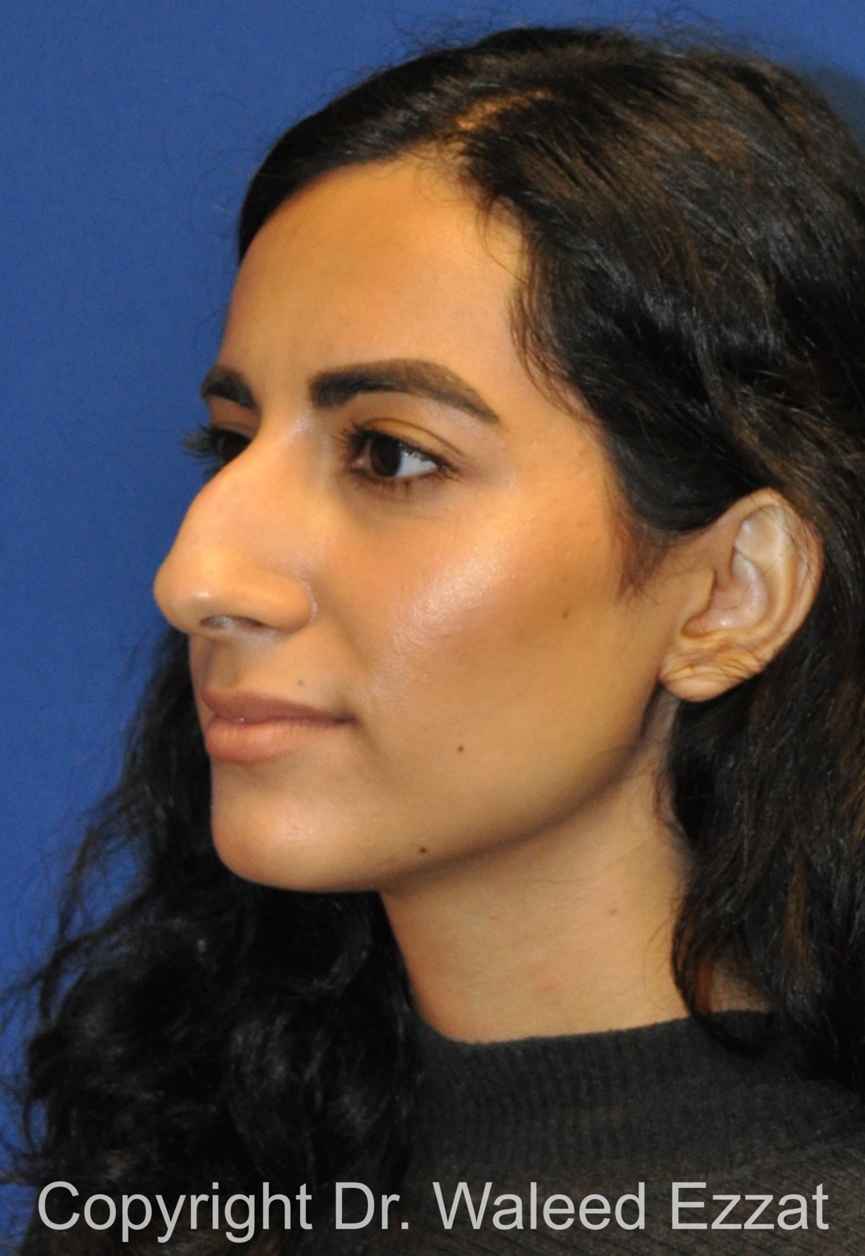 Rhinoplasty Patient Photo - Case 659 - before view-1
