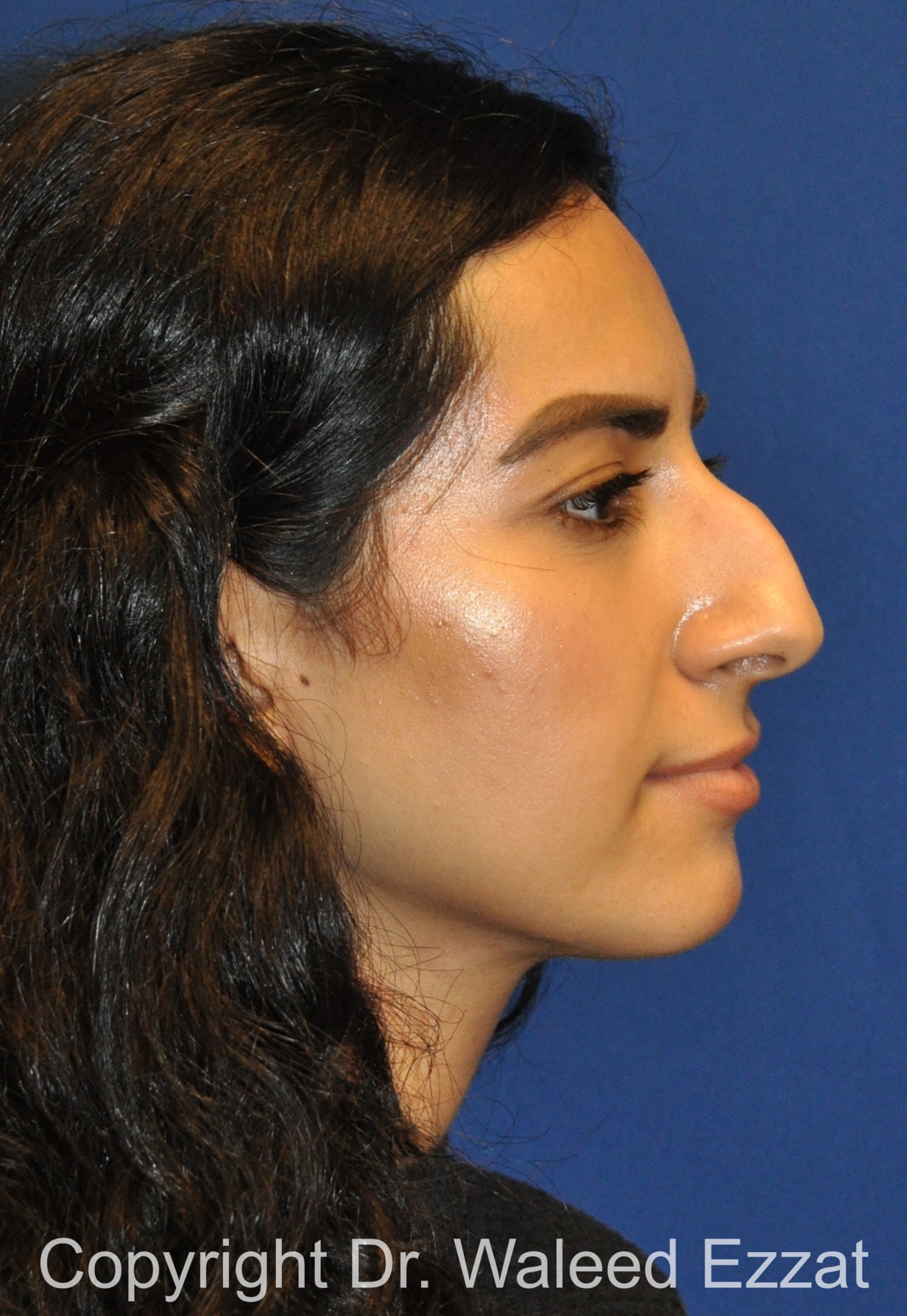 Rhinoplasty Patient Photo - Case 659 - before view-3