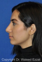 Mediterranean/Middle Eastern Rhinoplasty - Case 659 - After