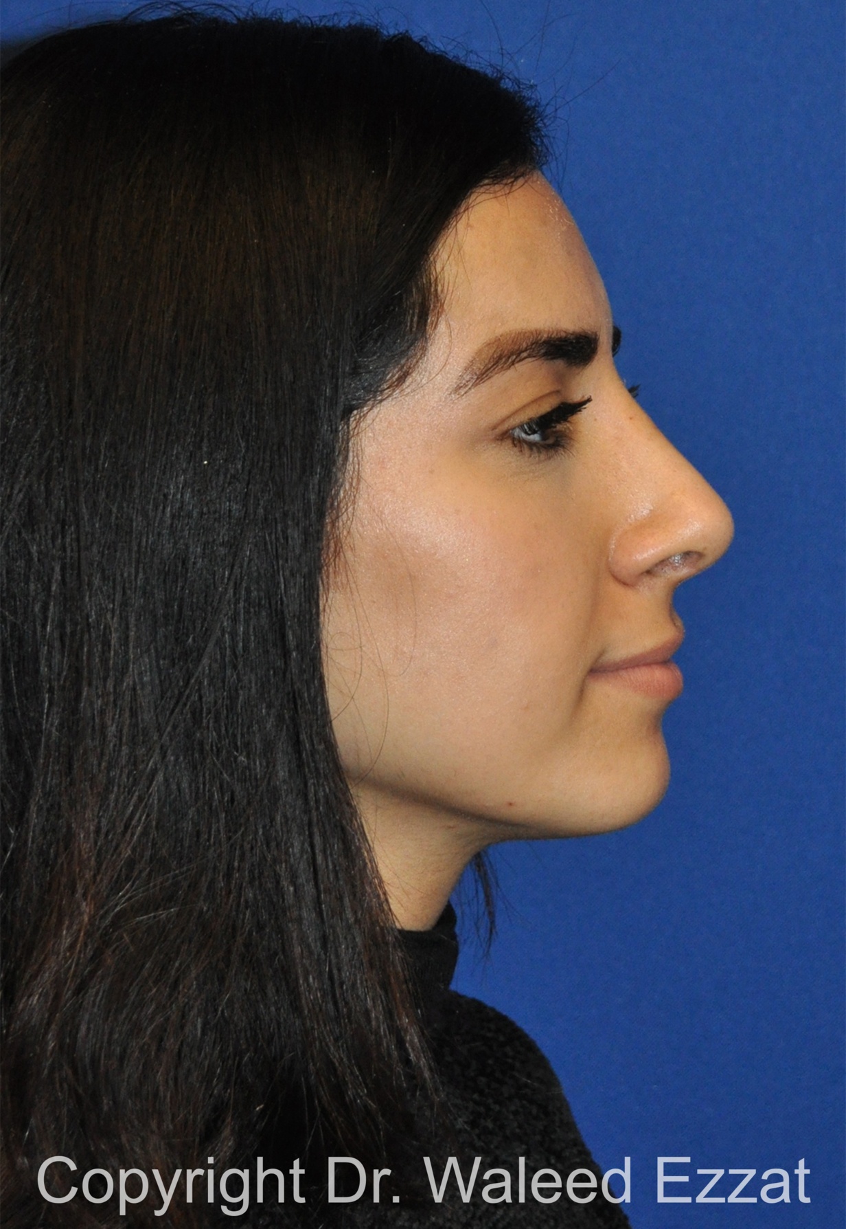 Rhinoplasty Patient Photo - Case 659 - after view-3