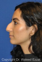 Mediterranean/Middle Eastern Rhinoplasty - Case 659 - Before