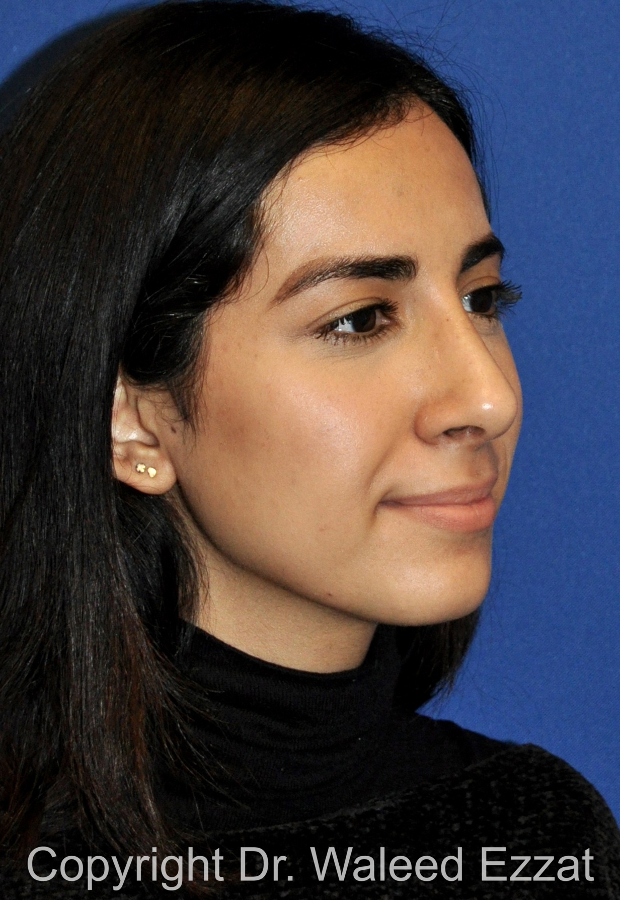 Rhinoplasty Patient Photo - Case 659 - after view-2