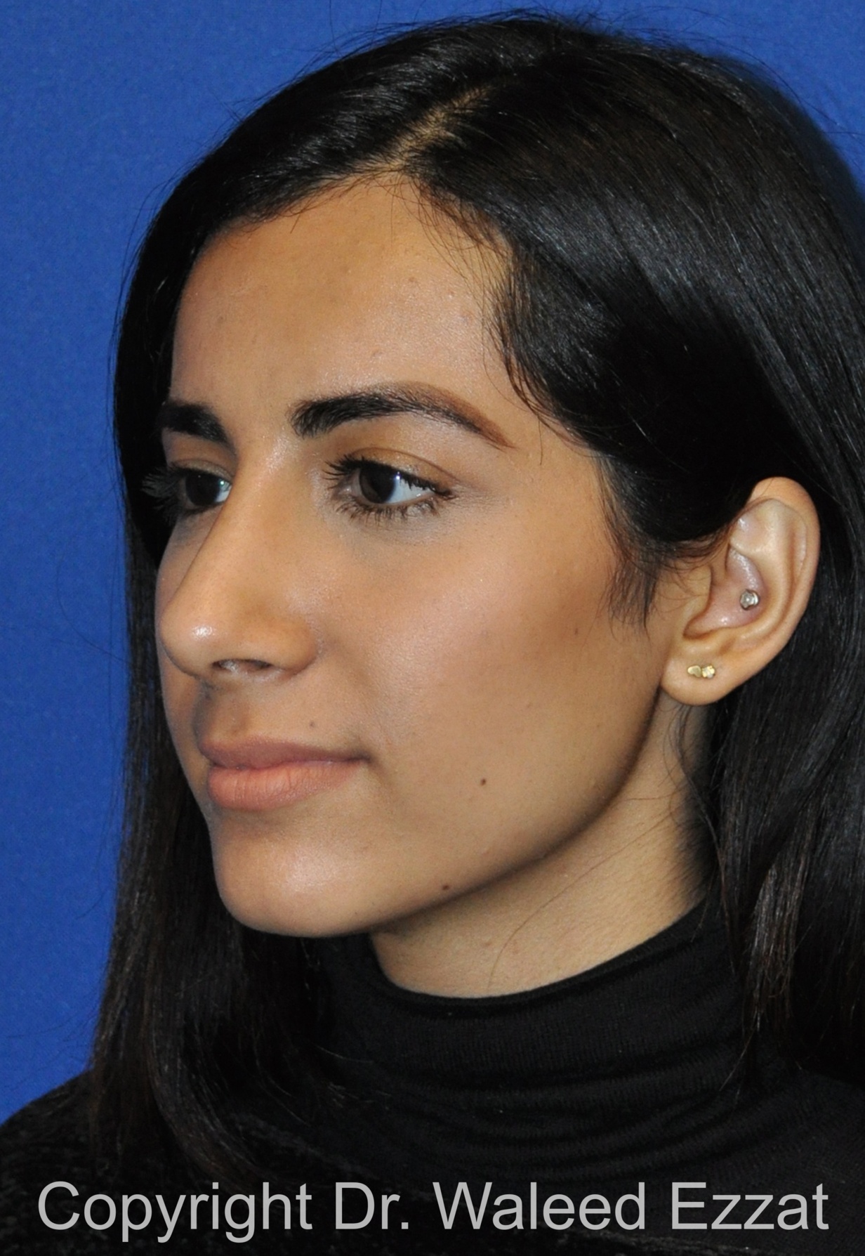 Rhinoplasty Patient Photo - Case 659 - after view-1