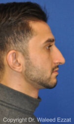 Mediterranean/Middle Eastern Rhinoplasty - Case 660 - Before
