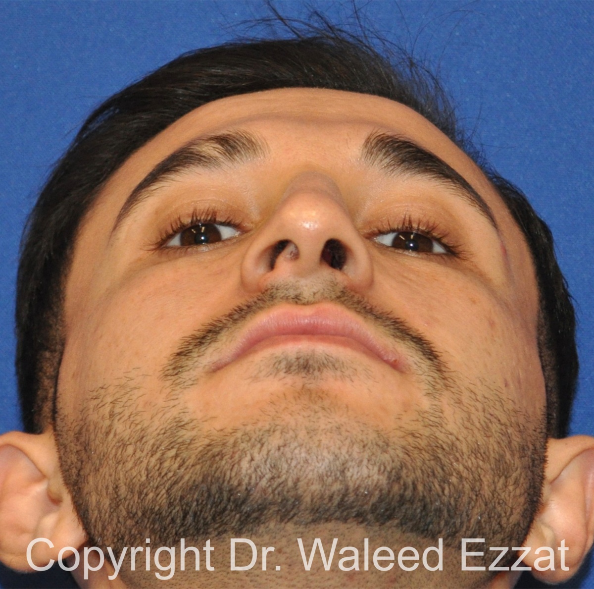 Mediterranean/Middle Eastern Rhinoplasty Patient Photo - Case 660 - before view-3