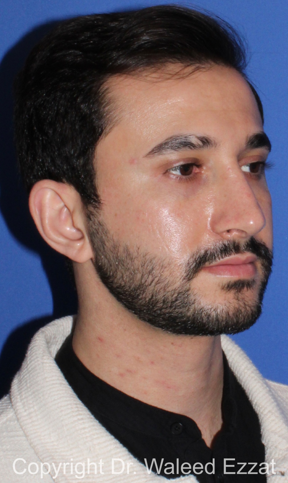 Mediterranean/Middle Eastern Rhinoplasty Patient Photo - Case 660 - after view-1