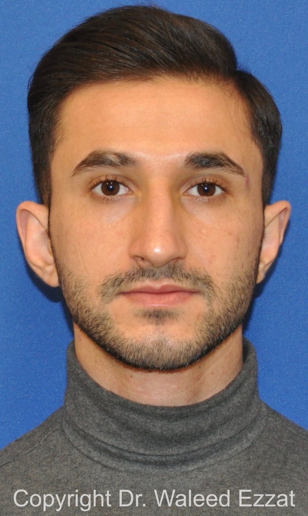 Mediterranean/Middle Eastern Rhinoplasty Patient Photo - Case 660 - before view-2